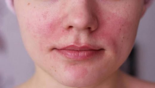 4 Must-Know Causes of Rosacea - YusraBlog.com